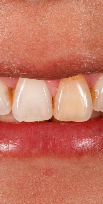 Before view of single discolored front tooth planned for indirect veneer in Maspeth Queens