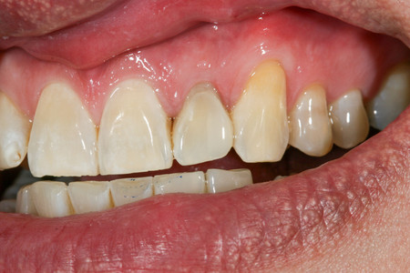 Emergency composite veneer treatment for a damaged front tooth at SOL Dental Arts, Maspeth Queens — case photo 2