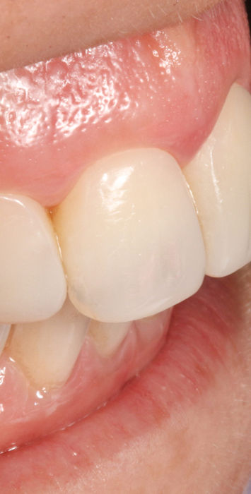 Close-up of cosmetic bonding contours on the upper front teeth after treatment.
