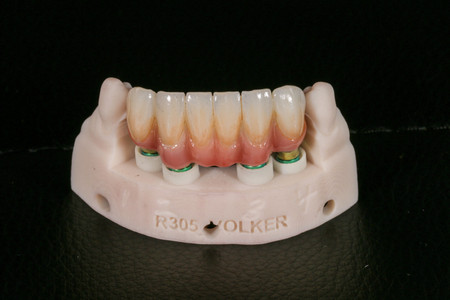Lower incisor and implant bridge smile refresh at SOL Dental Arts, Maspeth Queens — case photo 5