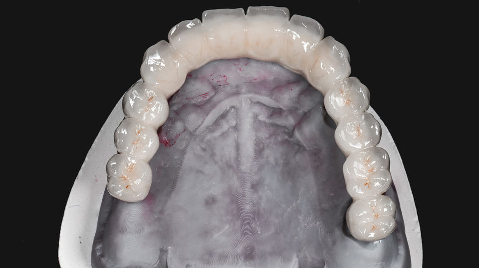 Full arch dental implant restoration smile view before and after at SOL Dental Arts