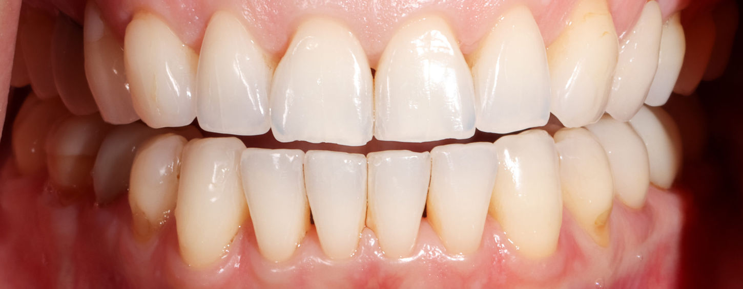 Additive composite bonding view showing improved tooth contours across the smile