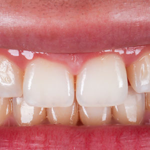 Post Orthodontic Smile Refinements - Minimally Invasive Bonding