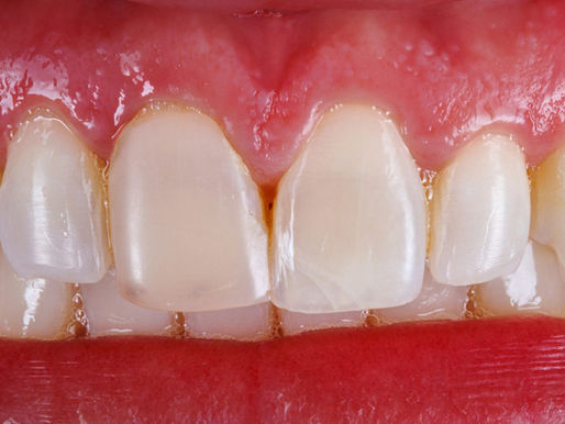 Before photo of one discolored front tooth treated with a direct composite veneer