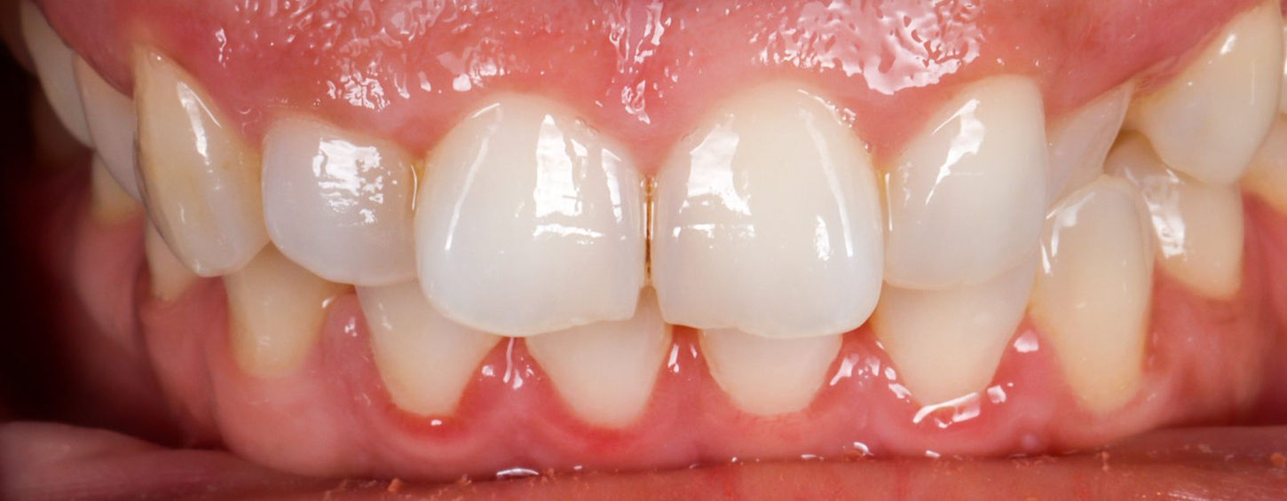 Before treatment, front view: the upper left canine recessed behind the smile line.
