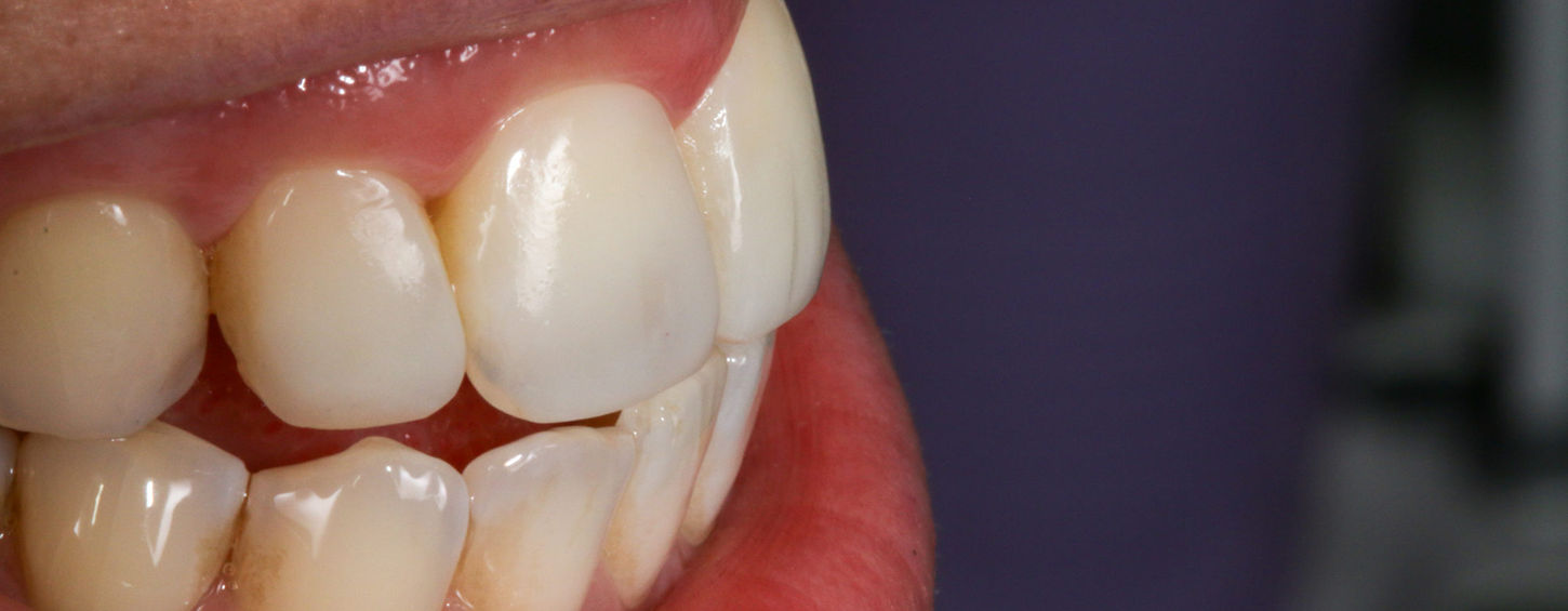 Final view of cosmetic bonding for upper central and lateral incisors.