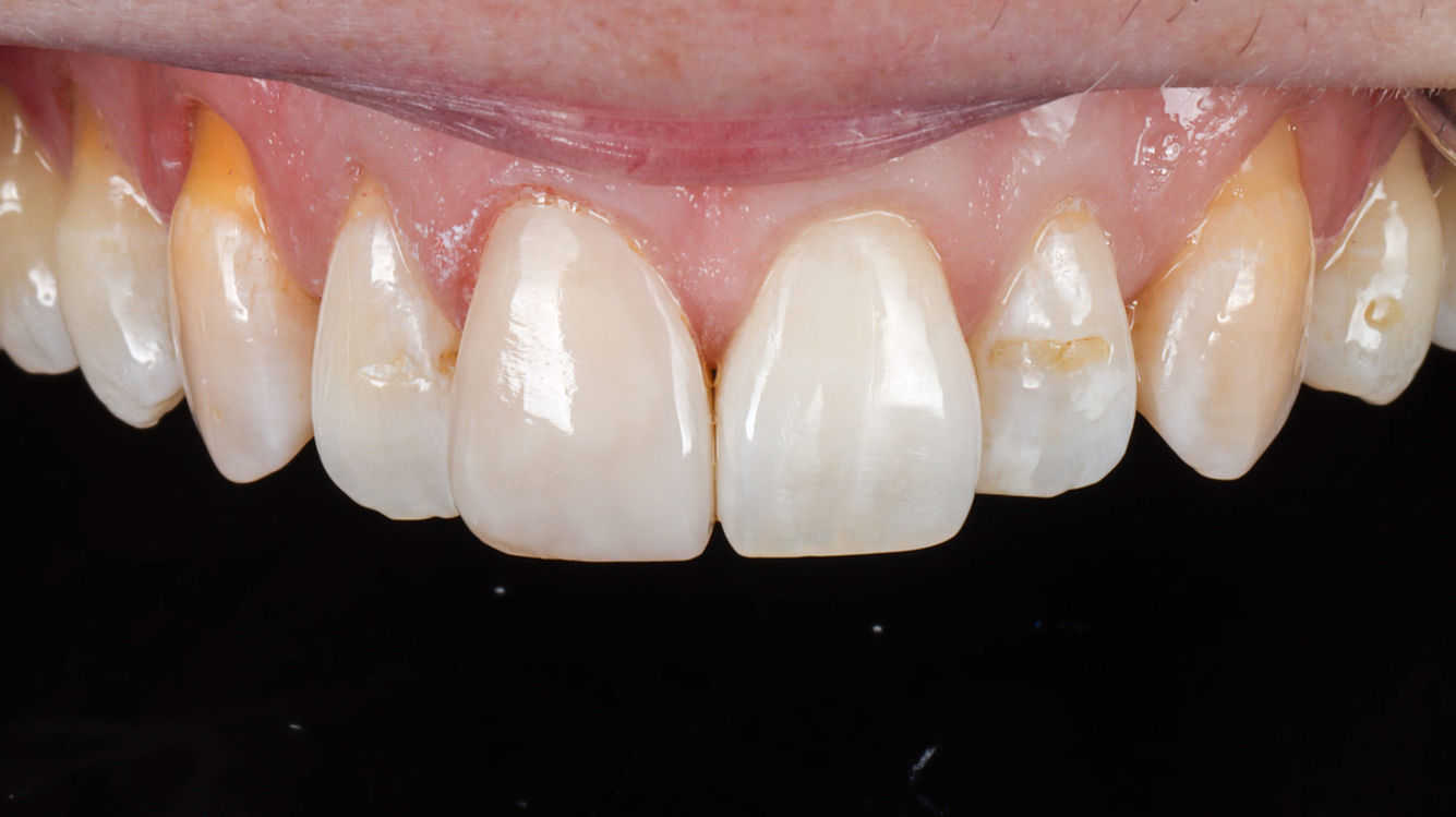 Full Smile Rehabilitation and Bite Reconstruction dental case photo 15 at SOL Dental Arts in Maspeth Queens
