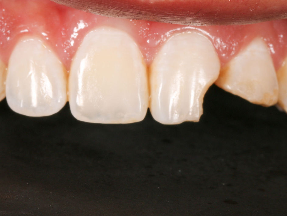 Facial trauma aesthetic dental repair before and after — cosmetic dentistry case at SOL Dental Arts in Maspeth, Queens