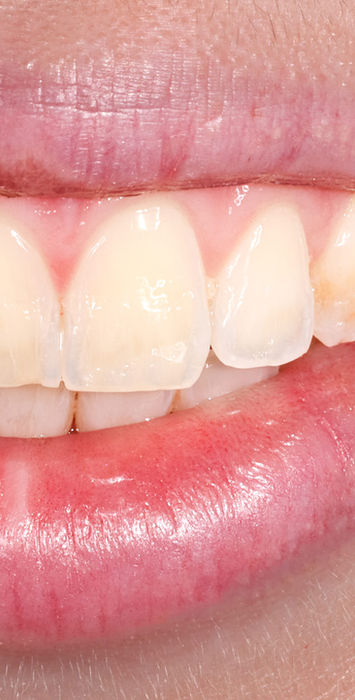 Pre-treatment smile-zone photo for composite bonding veneers on discolored front teeth