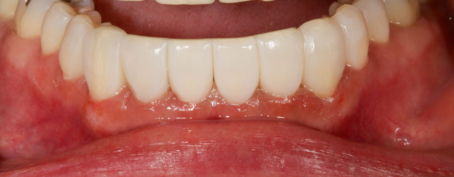 Gumline space closure with conservative composite bonding at SOL Dental Arts