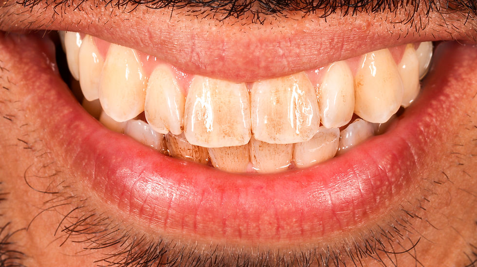 A Brighter Smile: Professional Teeth Whitening, A Case Study