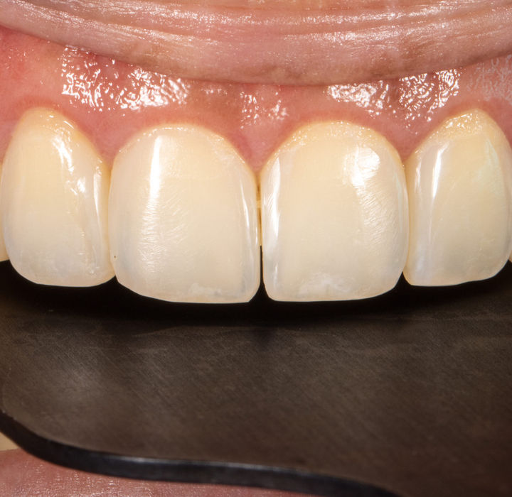 Portrait orientation view of Bioclear black triangle closure result