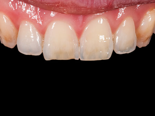 Matching One Discolored Tooth with an Indirect Veneer: A Case Study