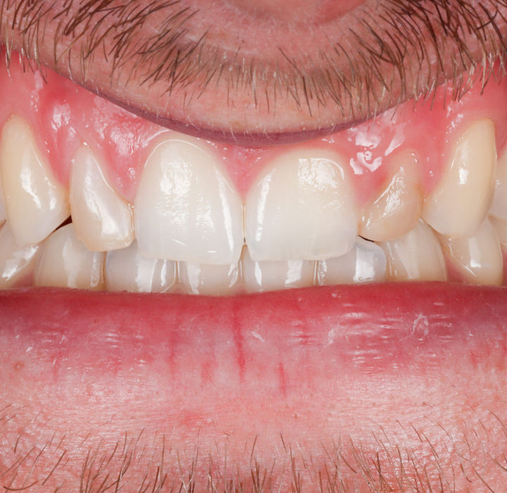 Maspeth Queens composite veneer case for peg-shaped lateral incisors