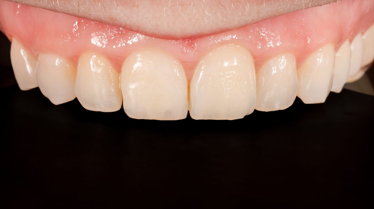 After close-up of front tooth restored with conservative composite bonding