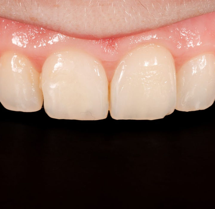 One-week follow-up, retracted close-up: the bonded upper right central incisor looking natural and blending with the adjacent teeth.