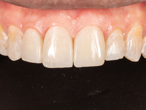 composite veneers, alternative to porcelain