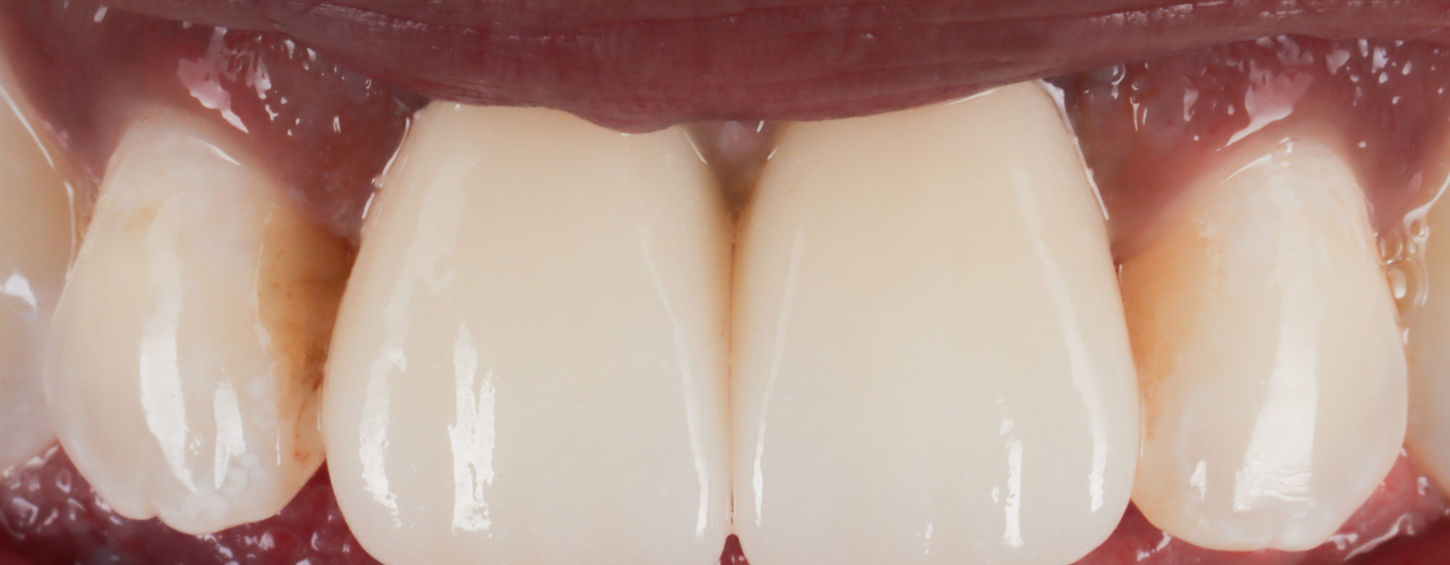 Implant crown after photo showing restored smile function and esthetics