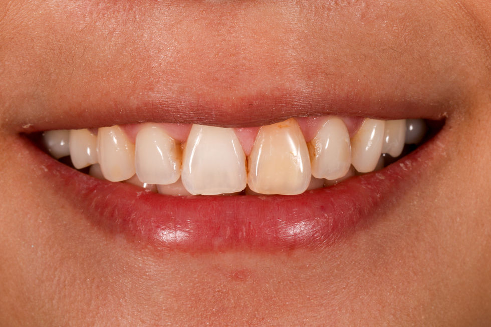 Indirect Veneers - Single Discolored Tooth