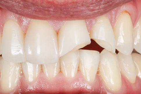 Trauma Composite bonding before and after – Maspeth Queens dentist