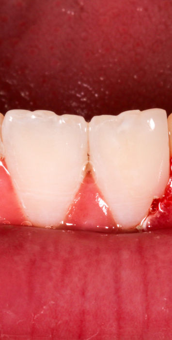 Final polished result after conservative bonding on a chipped mandibular incisor.