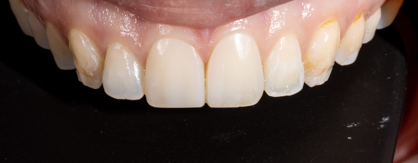 Post-treatment close-up of composite bonding veneers on discolored front teeth