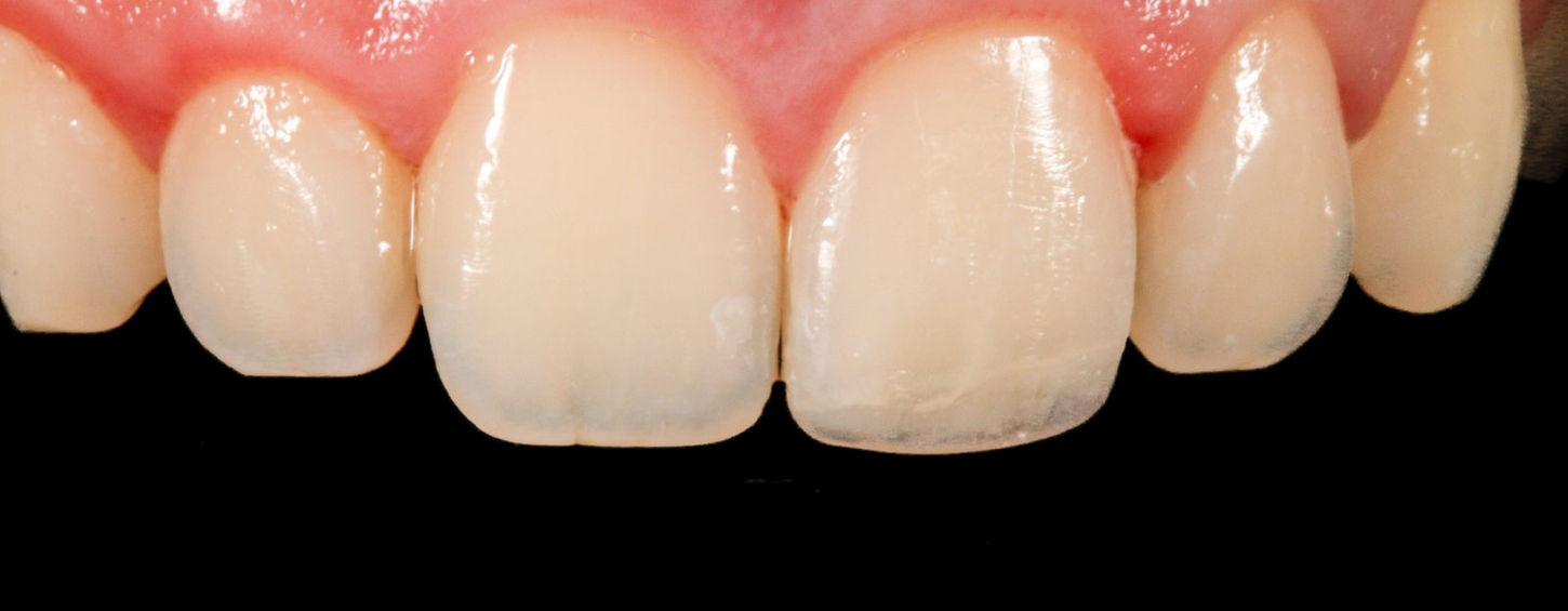 After same-day treatment, close-up: the central incisor rebuilt with tooth-colored composite bonding, matched to the neighboring tooth in shape and length.