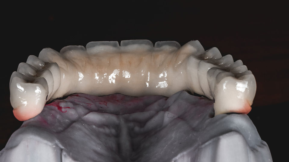 Full mouth implant rehabilitation planned for stable teeth and smile support
