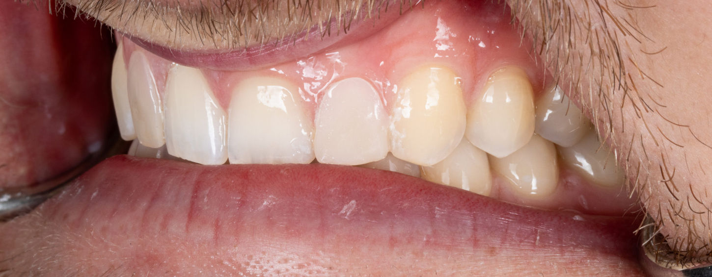 Composite veneer proportion refinement for small lateral incisors