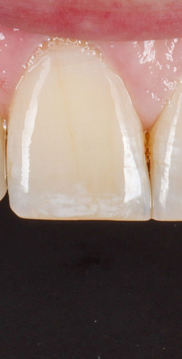 Clinical smile-zone photo for failing bonding replacement at SOL Dental Arts