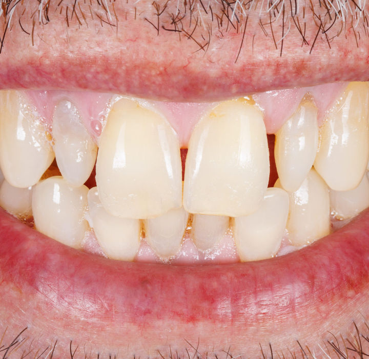 Close-up before ultrathin veneers for small lateral incisors at SOL Dental Arts