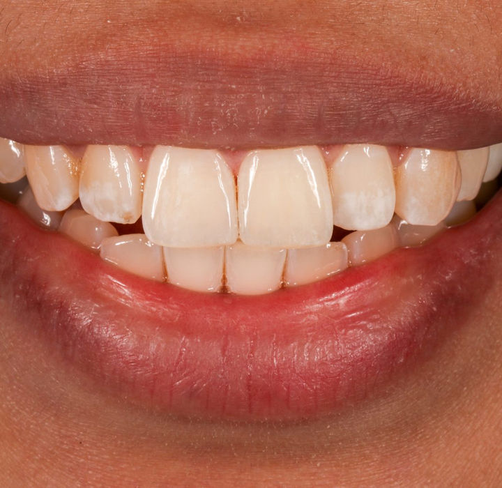 After: a balanced, symmetric smile following composite bonding.