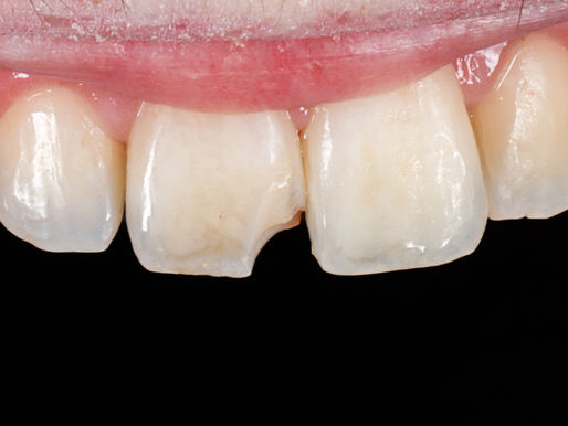 Repairing a Chipped Front Tooth with Composite Bonding: A Case Study
