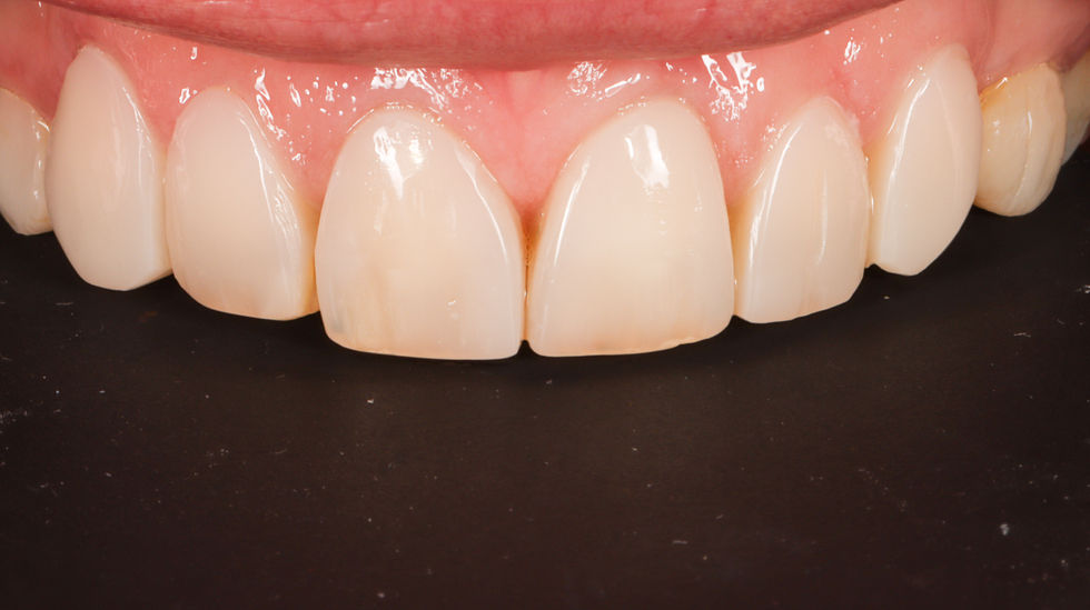 Smile makeover bonding and crowns before and after – Maspeth Queens dentist