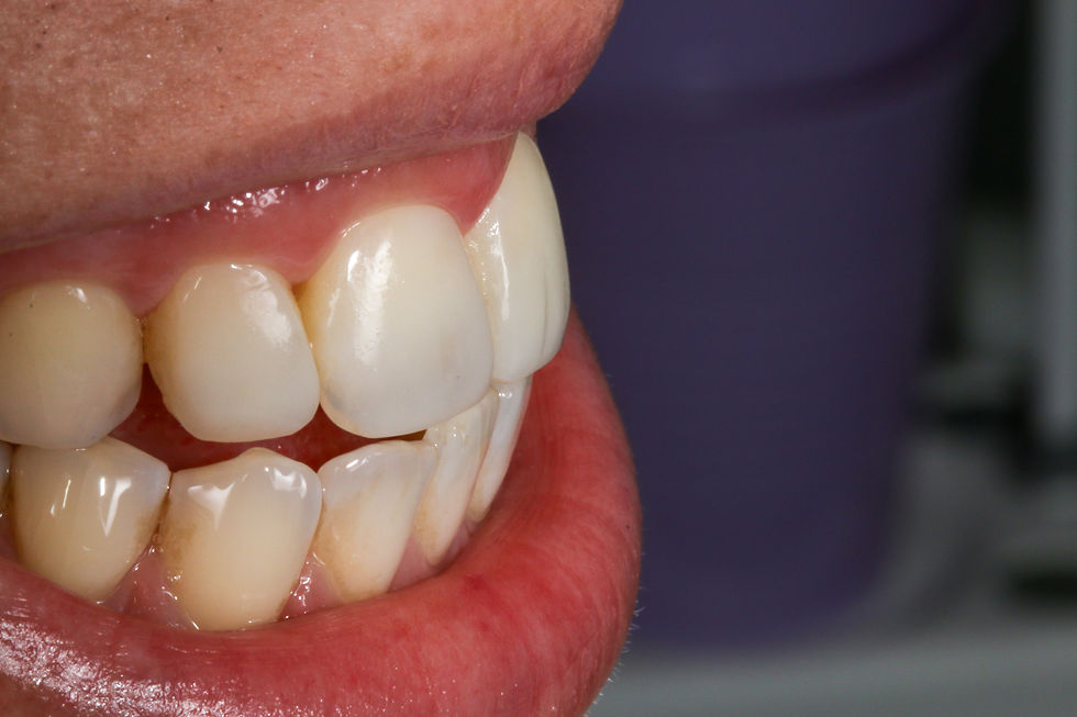 Refining Front-Tooth Symmetry with Cosmetic Bonding: A Case Study