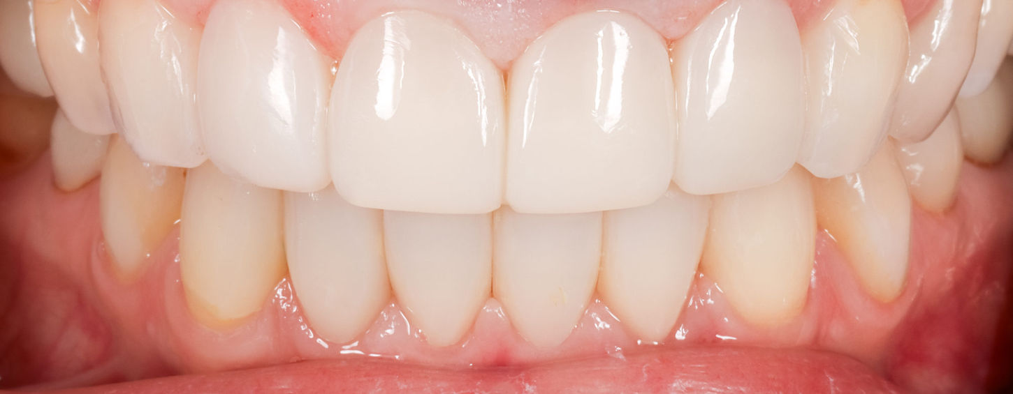 After additive full-mouth bonding showing cohesive tooth proportions
