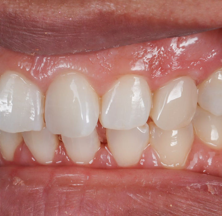 After treatment, side view: the upper left canine built out with composite bonding so it sits within the arch.