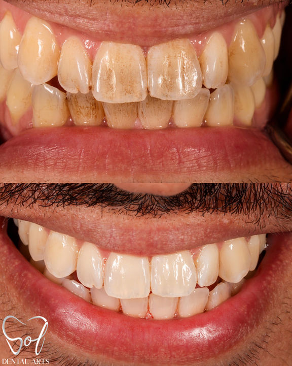 Professional teeth whitening treatment at SOL Dental Arts in Maspeth Queens