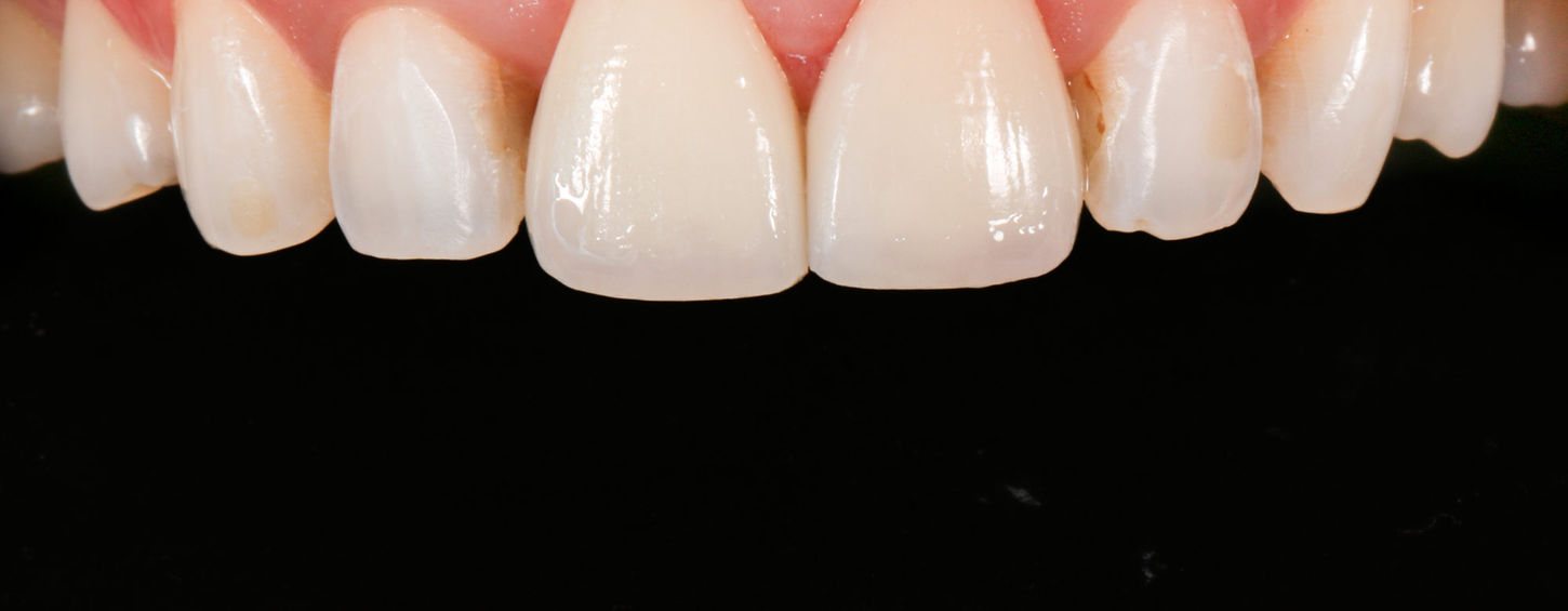 Indirect veneer result showing color correction and contour match on one tooth