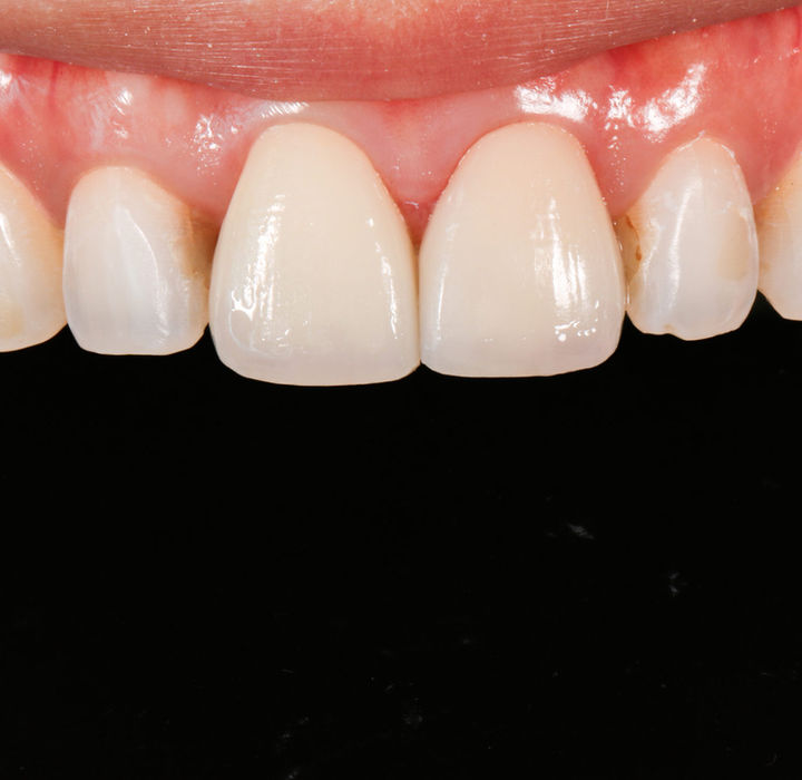 Indirect veneer result showing color correction and contour match on one tooth