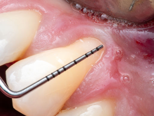 Gingival graft case for canine gum recession at SOL Dental Arts in Maspeth Queens