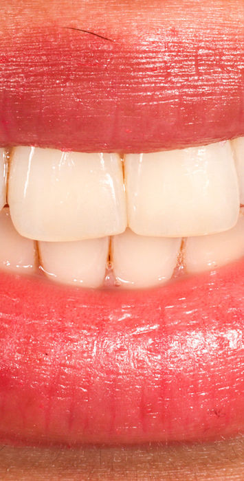 Before view of chipped front teeth planned for aesthetic composite bonding repair
