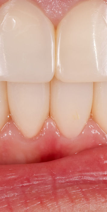 Close-up after full-mouth bonding showing natural composite contours