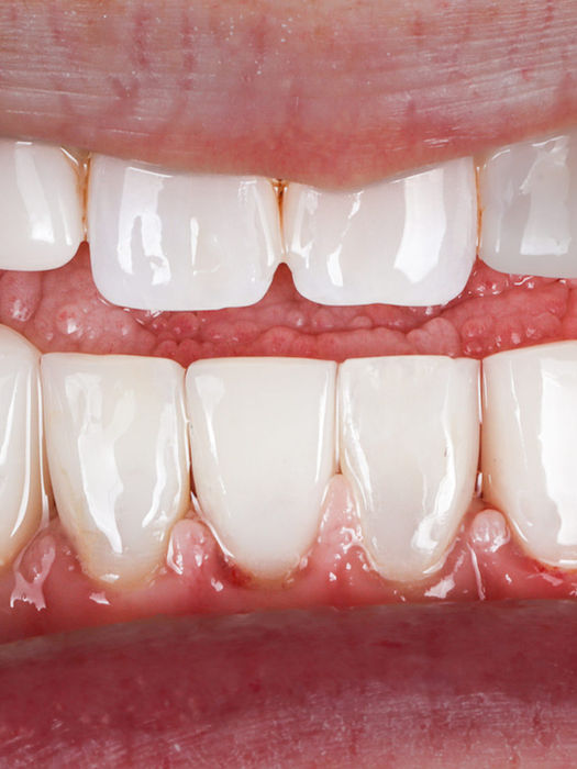 Black triangles between the lower front teeth closed with the Bioclear method — before and after at SOL Dental Arts, Maspeth, Queens