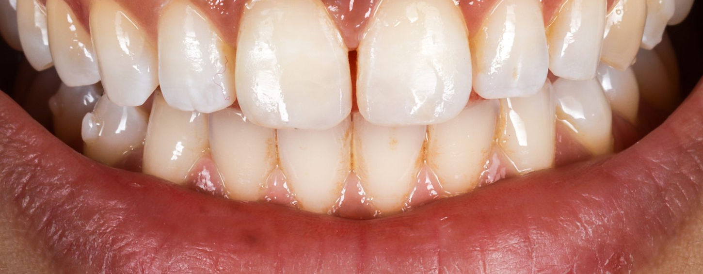 Before: a closed, even smile after the patient's natural midline gap was bonded shut years earlier.