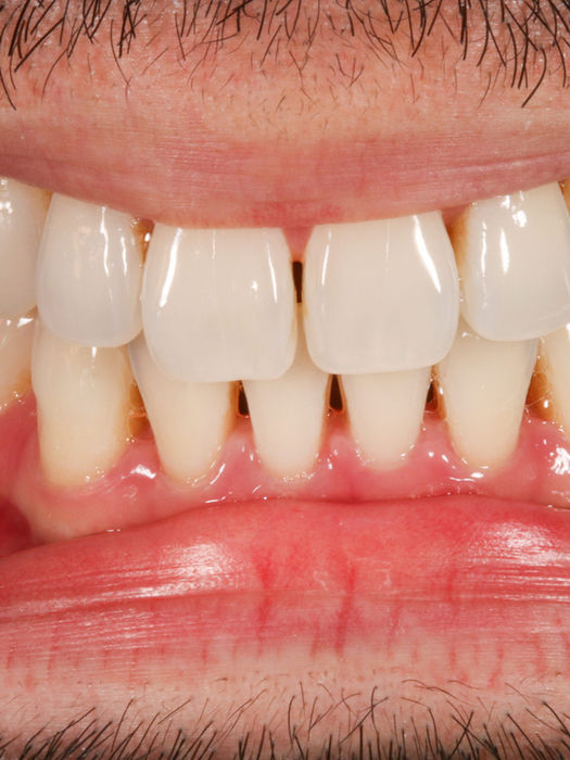 Bioclear bonding space closure before and after — cosmetic dentistry case at SOL Dental Arts in Maspeth, Queens