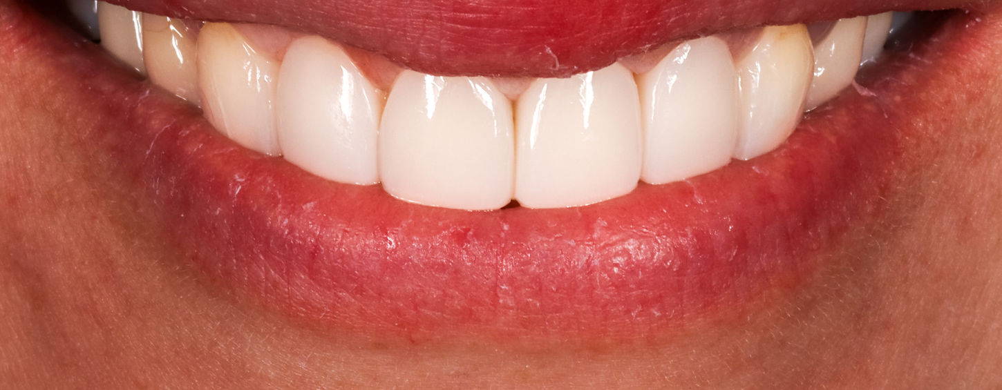 Final full-mouth additive bonding result for misshapen teeth in Queens