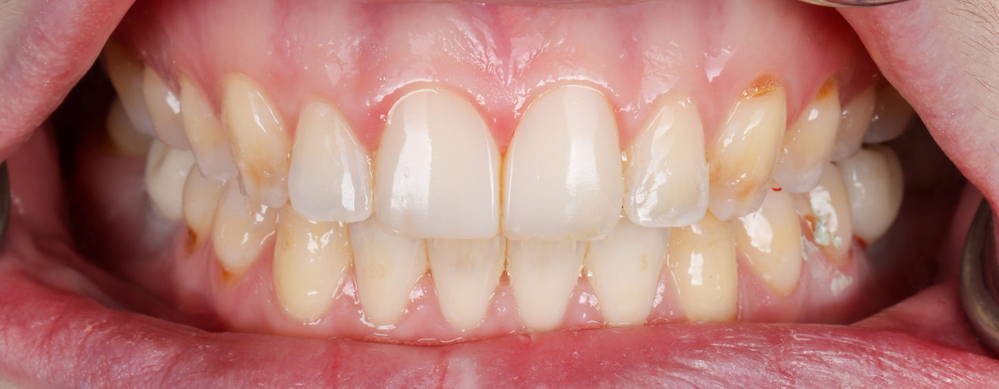 Completed composite bonding veneer case for discolored front teeth at SOL Dental Arts