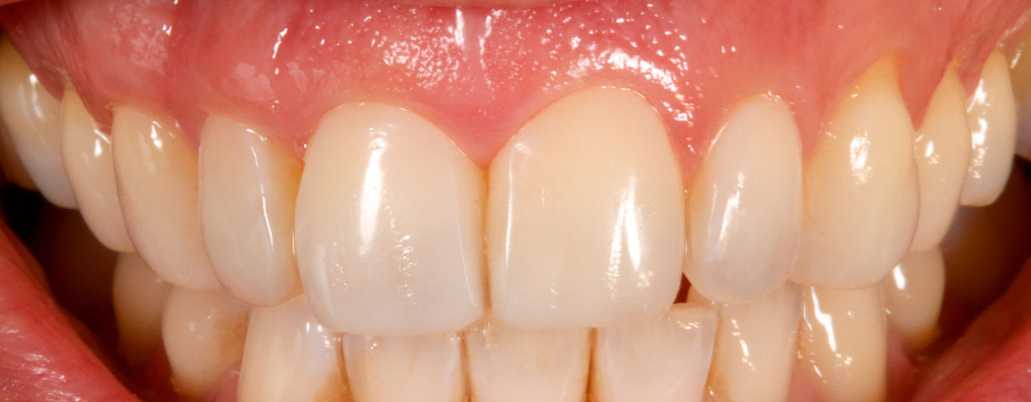 Cosmetic bonding result showing smoother contours on upper front teeth.