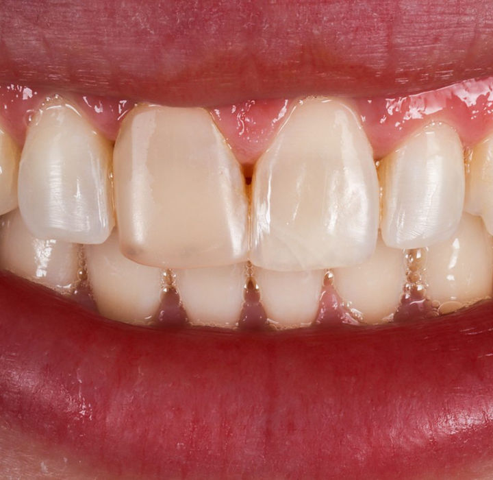Before treatment, natural smile: one upper central incisor stands out as greyer and more opaque than its neighbor, unbalancing the smile.